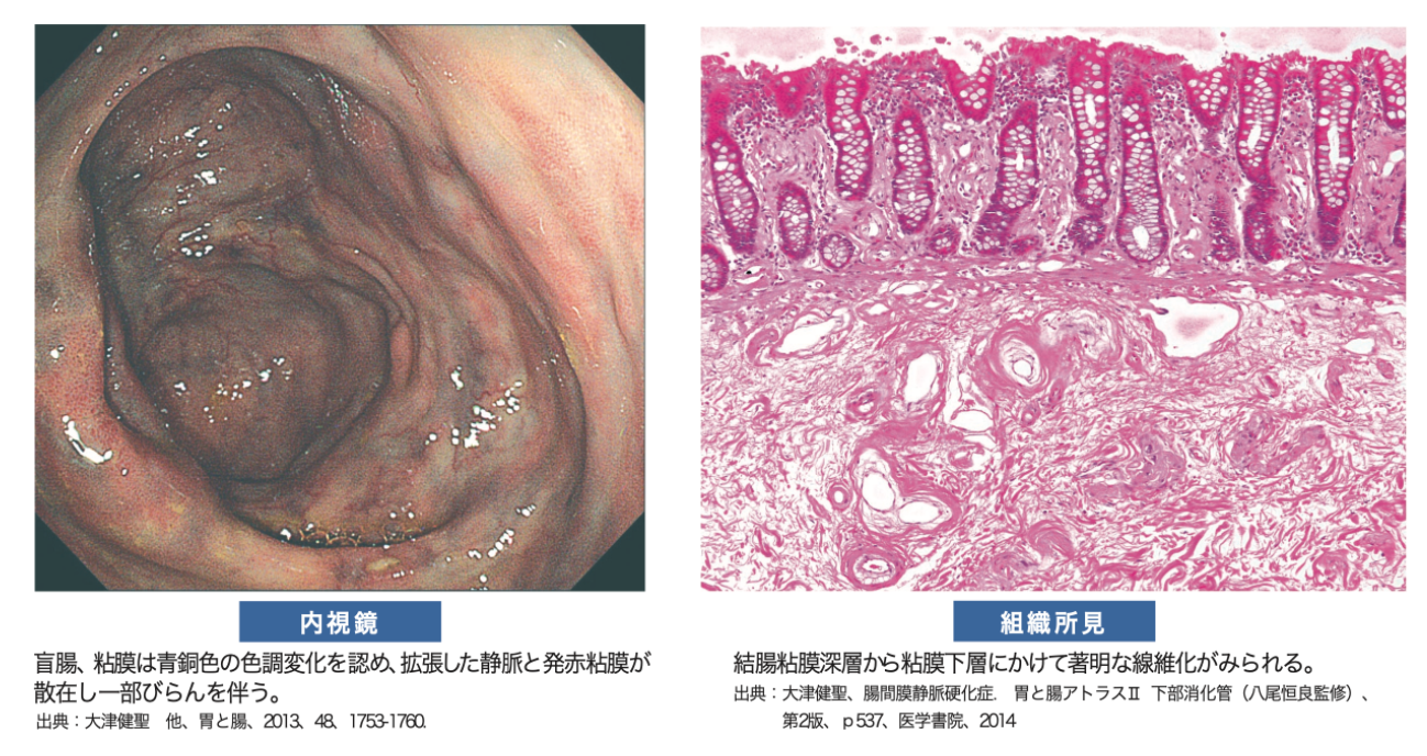 腸間膜静脈硬化症 漢方｜ある内科医のまとめ